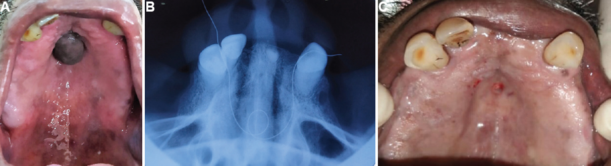 (A) Pre-operative picture showing growth in the mid-palate. (B) Occlusal radiograph with string showing no bony involvement. (C) Picture showing immediately after excision of growth in the mid-palate.